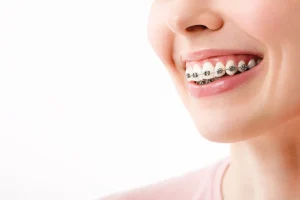 Braces