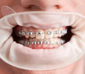 Braces Price