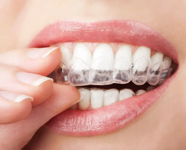 invisalign braces