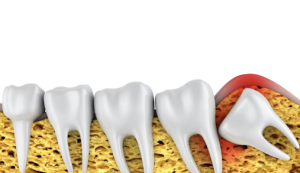 set of teeth with wisdom tooth pushing onto the other teeth