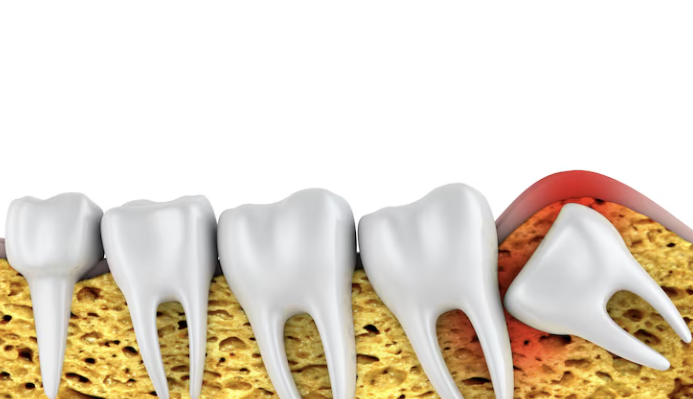 set of teeth with wisdom tooth pushing onto the other teeth