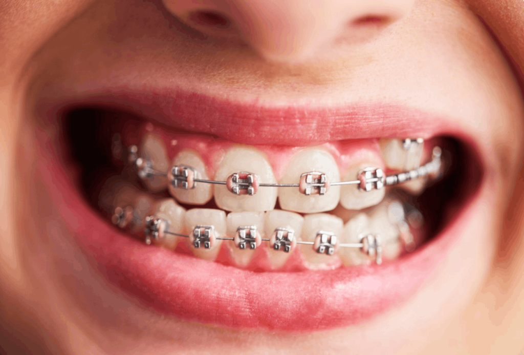 picture of a set of braces