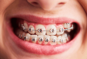 picture of a set of braces