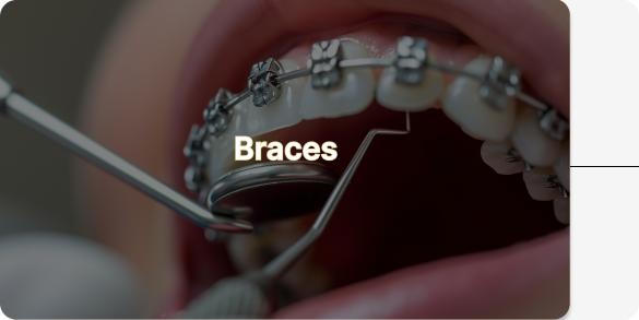 Braces