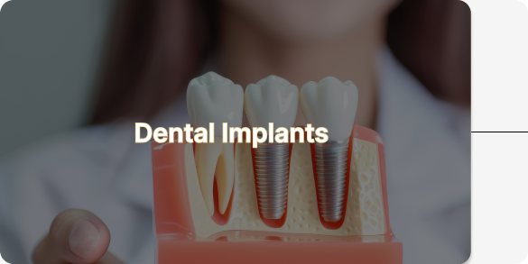 Dental Implant