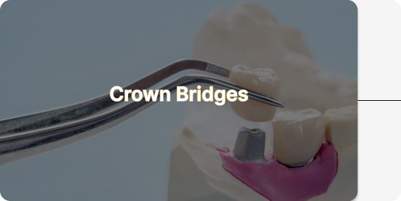 Crown Bridges