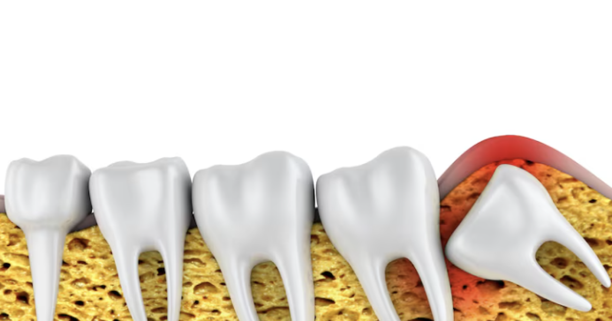 set of teeth with wisdom tooth pushing onto the other teeth