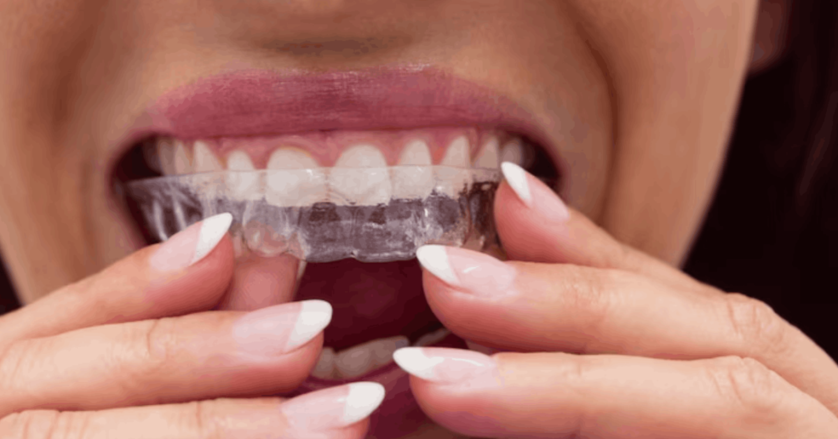 woman putting on invisalign braces