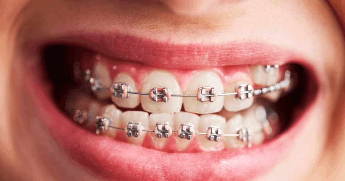 picture of a set of braces